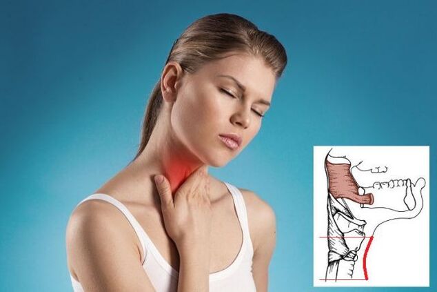 Sore throat with cervical spondylosis