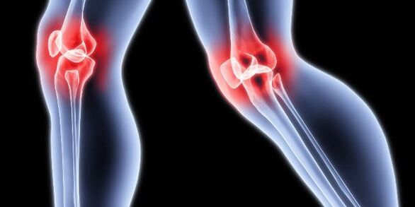 Arthritis