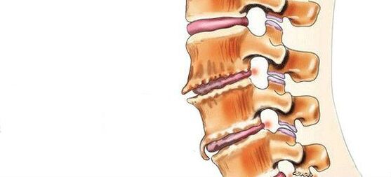What is arthritis