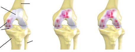 The degree of arthritis