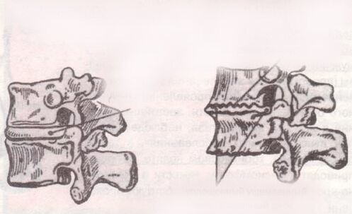 Healthy Intervertebral and lumbar osteoarthritis
