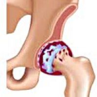 Arthrosis of hip joints