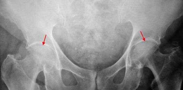 Coksartrostrosis double -sided of joint distance, stiffness of the joint surface