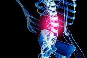 Osteoarthritis of the lumbar spine