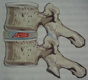 Early stage of osteochondrosis