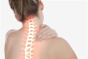 Cervical spondylosis in women
