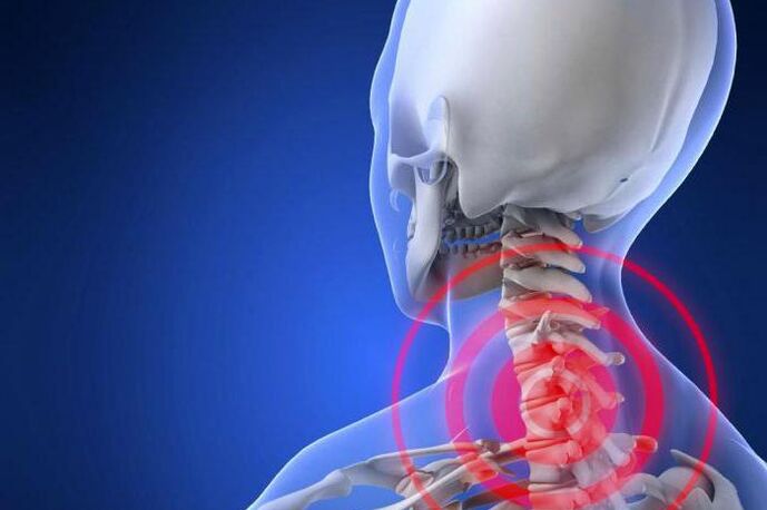 Neck pain is an early sign of cervical spondylosis