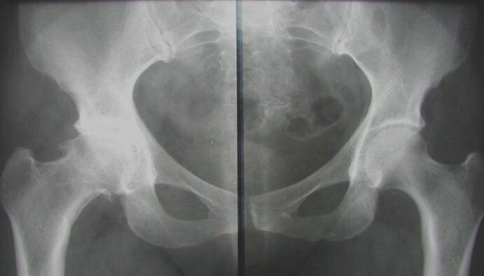 X-ray of the affected hip with arthritis